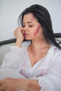woman, bruise, domestic violence, harassment, hurt, pain, portrait